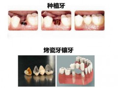 镶牙和种牙有什么区别哪个好？良心医生不建议种植牙？