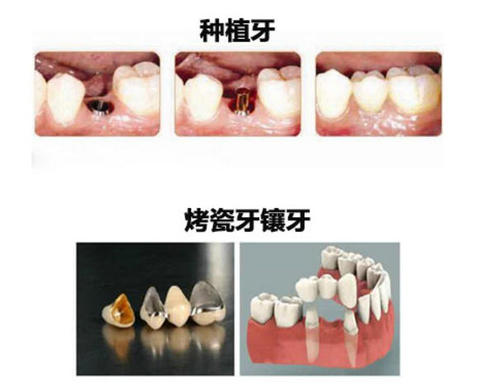 镶牙和种牙有什么区别哪个好？良心医生不建议种植牙？