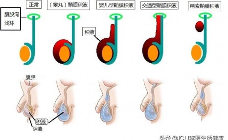 鞘膜积液必须手术吗?怎么治疗小儿鞘膜积液呢?