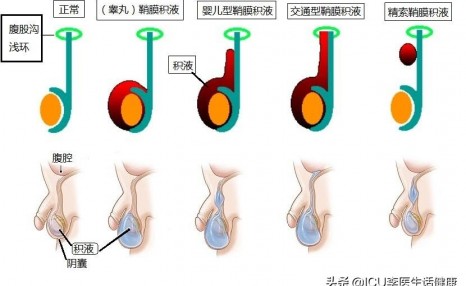 交通性鞘膜积液图片图片