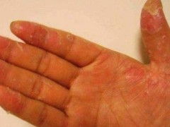 手掉皮怎么治疗？手脱皮是什么原因导致的？附原因和解决方法