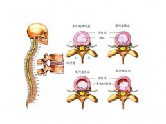腰椎间盘突出症的非手术疗方法