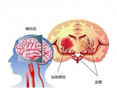 脑出血急救方法！家人突发脑出血怎么治疗？应该怎么办？