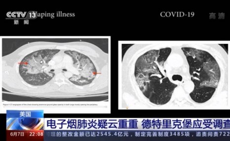 “溯源疑云”：2019年美国电子烟肺炎与新冠症状几乎无异